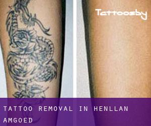 Tattoo Removal in Henllan Amgoed