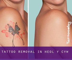 Tattoo Removal in Heol-y-Cyw