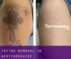 Tattoo Removal in Hertfordshire