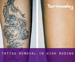 Tattoo Removal in High Roding