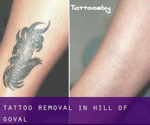 Tattoo Removal in Hill of Goval