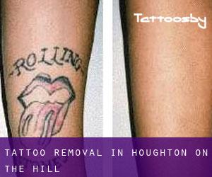 Tattoo Removal in Houghton on the Hill