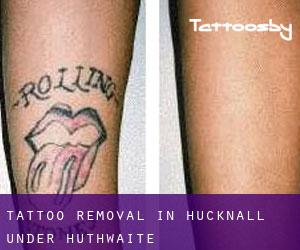 Tattoo Removal in Hucknall under Huthwaite