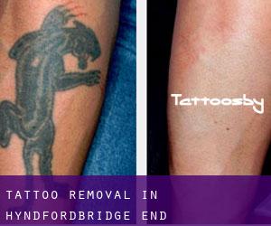 Tattoo Removal in Hyndfordbridge-end