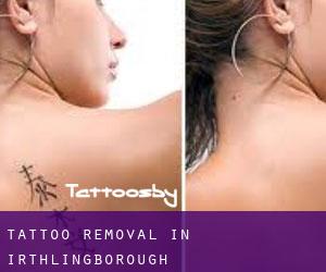 Tattoo Removal in Irthlingborough