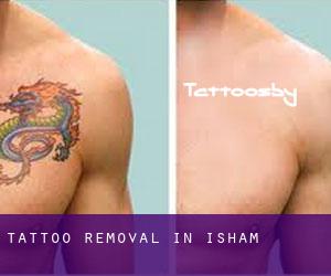 Tattoo Removal in Isham