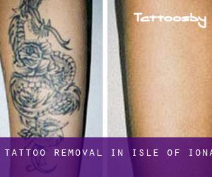 Tattoo Removal in Isle of Iona