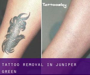 Tattoo Removal in Juniper Green