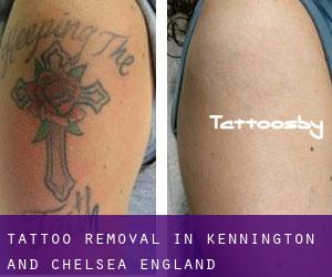 Tattoo Removal in Kennington and Chelsea (England)