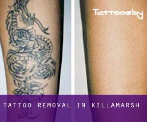 Tattoo Removal in Killamarsh