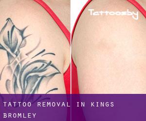 Tattoo Removal in Kings Bromley
