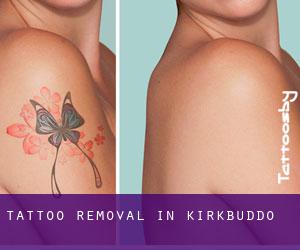 Tattoo Removal in Kirkbuddo