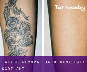 Tattoo Removal in Kirkmichael (Scotland)