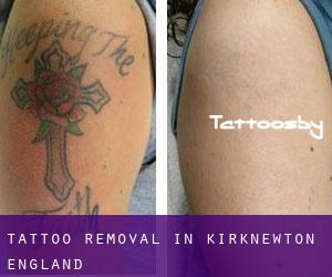 Tattoo Removal in Kirknewton (England)