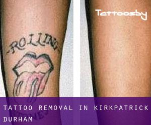 Tattoo Removal in Kirkpatrick Durham