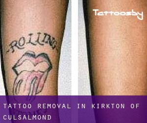 Tattoo Removal in Kirkton of Culsalmond