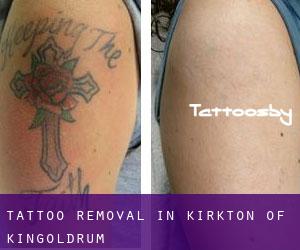 Tattoo Removal in Kirkton of Kingoldrum