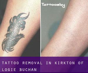 Tattoo Removal in Kirkton of Logie Buchan