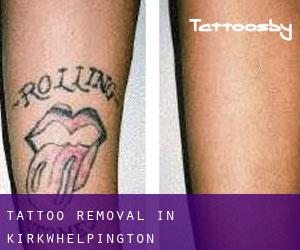 Tattoo Removal in Kirkwhelpington