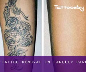 Tattoo Removal in Langley Park