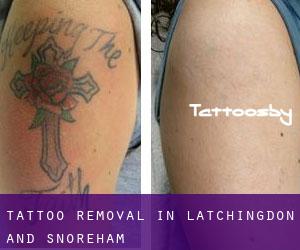 Tattoo Removal in Latchingdon and Snoreham