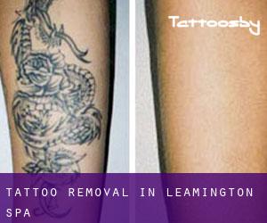 Tattoo Removal in Leamington Spa
