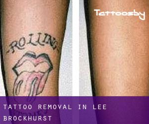 Tattoo Removal in Lee Brockhurst