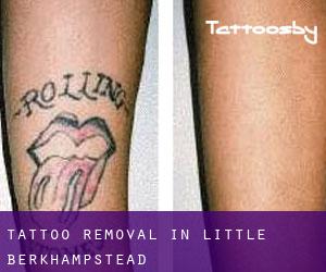 Tattoo Removal in Little Berkhampstead