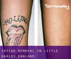 Tattoo Removal in Little Oakley (England)