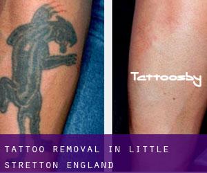 Tattoo Removal in Little Stretton (England)