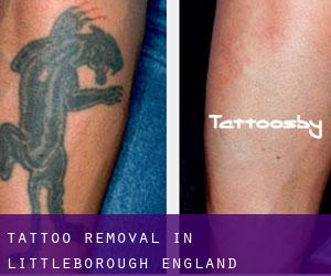 Tattoo Removal in Littleborough (England)