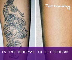 Tattoo Removal in Littlemoor
