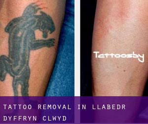 Tattoo Removal in Llabedr-Dyffryn-Clwyd