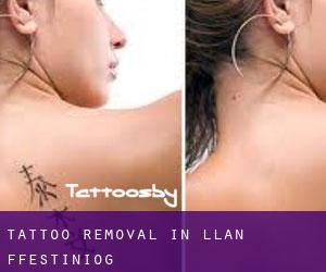Tattoo Removal in Llan Ffestiniog