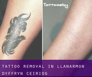 Tattoo Removal in Llanarmon Dyffryn-Ceiriog