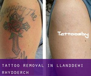 Tattoo Removal in Llanddewi Rhydderch