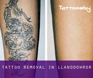 Tattoo Removal in Llanddowror