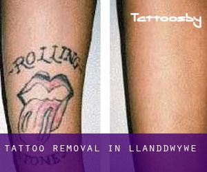 Tattoo Removal in Llanddwywe