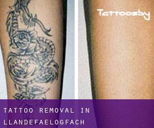 Tattoo Removal in Llandefaelogfâch
