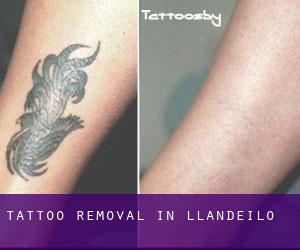 Tattoo Removal in Llandeilo