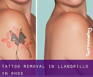 Tattoo Removal in Llandrillo-yn-Rhôs