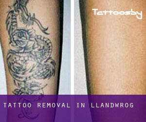 Tattoo Removal in Llandwrog