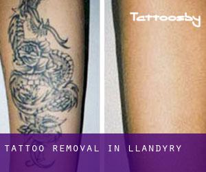 Tattoo Removal in Llandyry