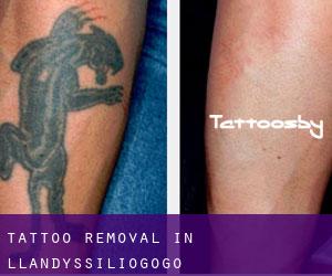 Tattoo Removal in Llandyssiliogogo