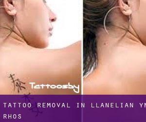 Tattoo Removal in Llanelian-yn-Rhôs