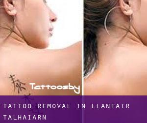 Tattoo Removal in Llanfair Talhaiarn