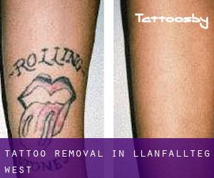 Tattoo Removal in Llanfallteg West