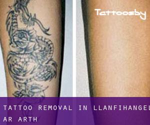 Tattoo Removal in Llanfihangel-ar-Arth