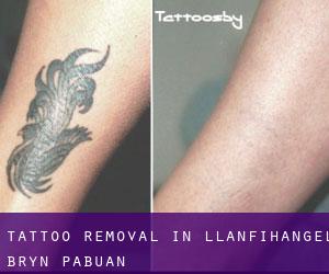 Tattoo Removal in Llanfihangel-Bryn-Pabuan