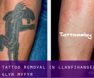 Tattoo Removal in Llanfihangel-Glyn-Myfyr